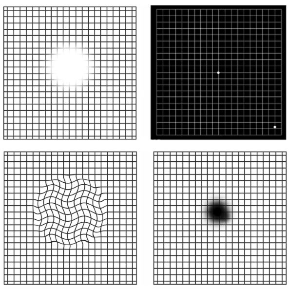 눈에 이상이 있을 경우, 바라본 암슬러 격자